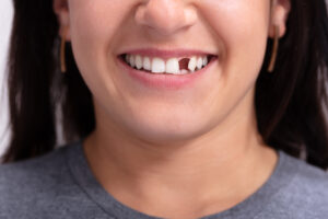 woman with missing teeth in Grand Prairie